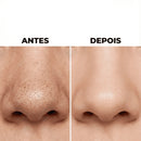 Removedor de Cravos e Espinhas a Vácuo Beauty Clean